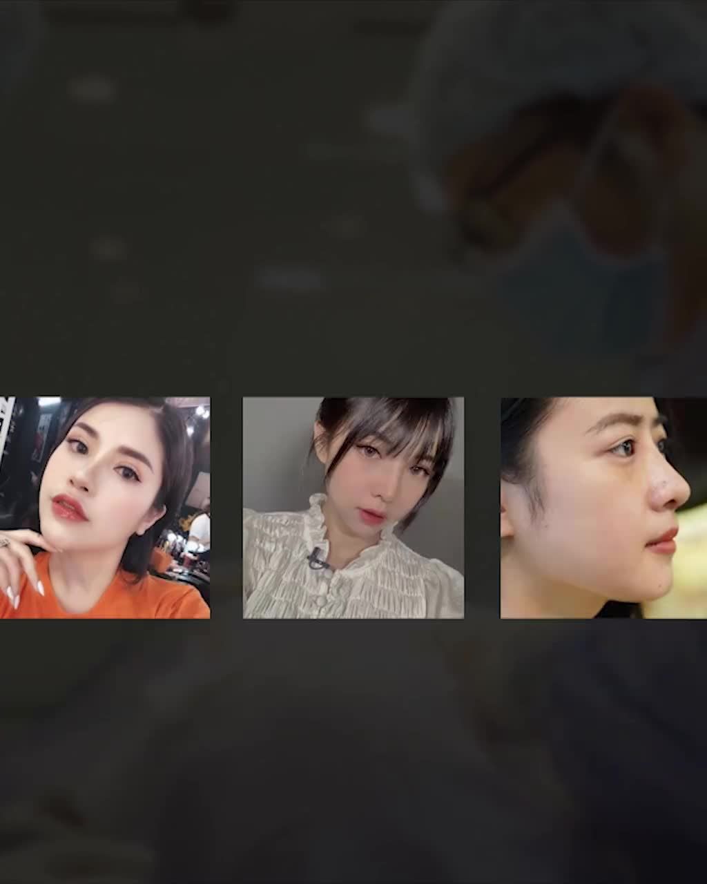 Hóa cô nàng trẻ trung rạng rỡ chỉ sau 7 ngày thực hiện Cắt mí tại Dr.Hải Lê