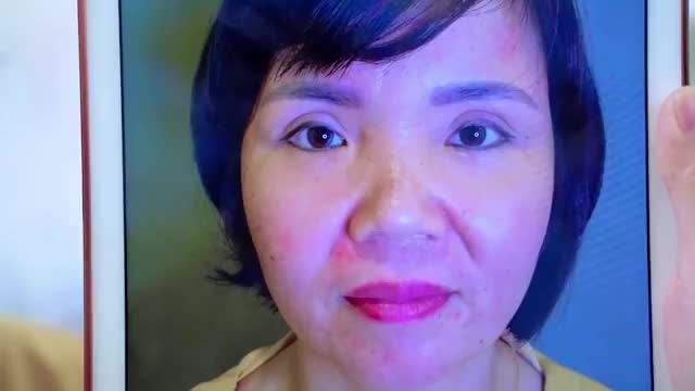 BÁC SĨ LÀM VIỆC XUYÊN TRƯA GIẢI CỨU THÀNH CÔNG CA MÍ LỖI HỎNG NẶNG DO THỰC HIỆN TẠI SPA