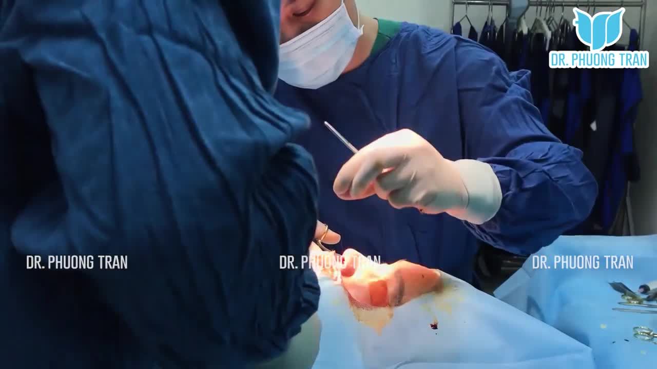 Chị đến gặp tôi với dáng mũi thô, cứng, hơi cao làm da mũi căng cứng,... (do đã làm ở nơi khác).