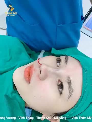 Nâng mũi bán cấu trúc bọc Megaderm Sau 90 phút thực hiện: