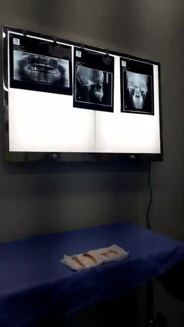 SỐC! Cận cảnh xương góc hàm  xương gò má được lấy ra ngay tại phòng phẫu thuật