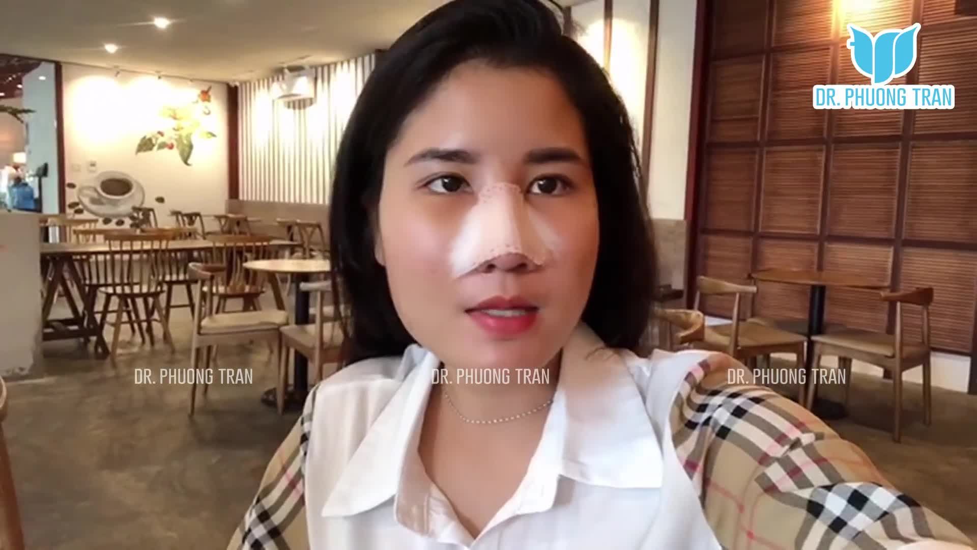 2 ngày đi xe khách, 3 ngày đi cà phê sau nâng mũi sẽ thế nào?