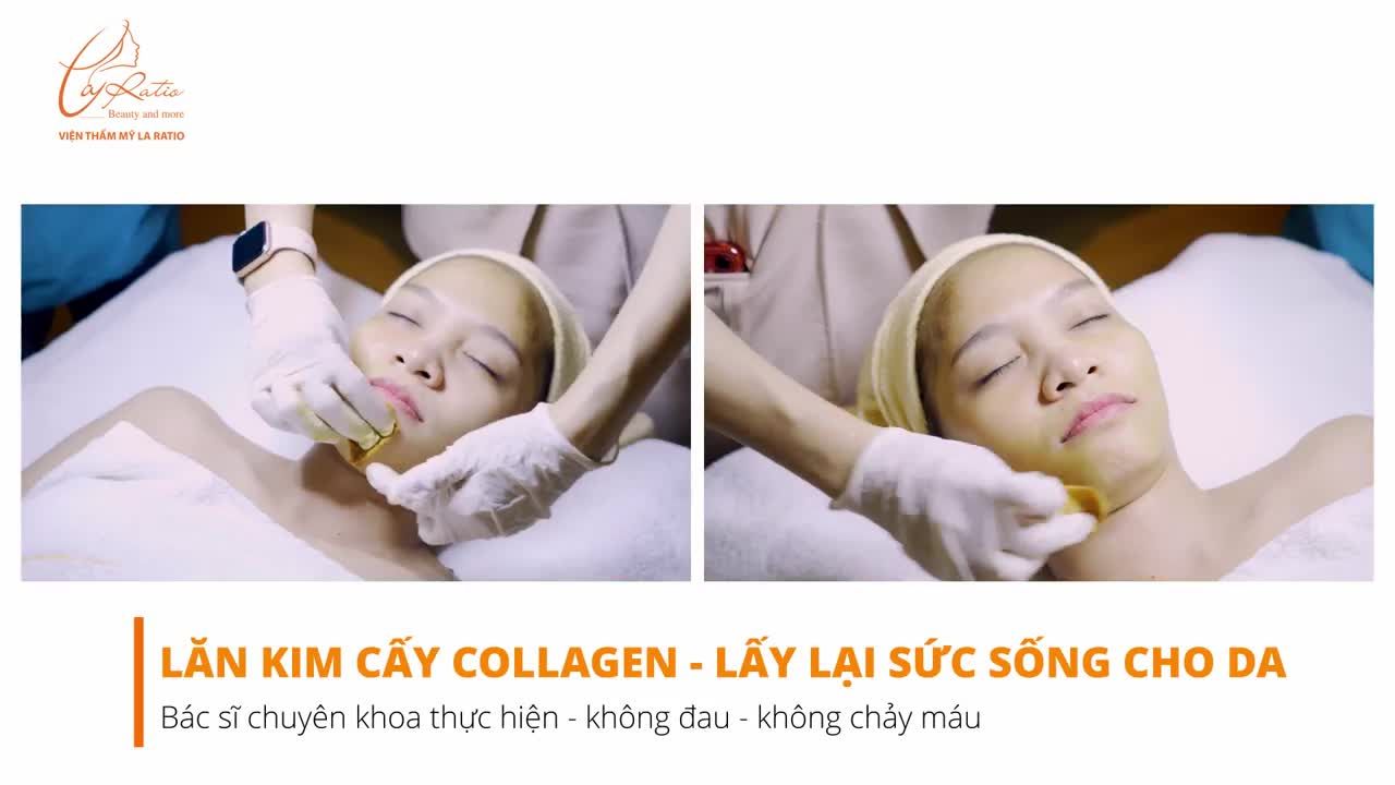 BÁC SĨ THỰC HIỆN LĂN KIM CẤY TINH CHẤT COLLAGEN  DA CĂNG MƯỚT KHÔNG ĐAU KHÔNG CHẢY MÁU