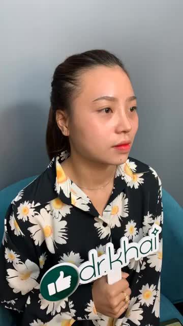 Dáng mũi cấu trúc sửa lại sau 10 ngày tái khám