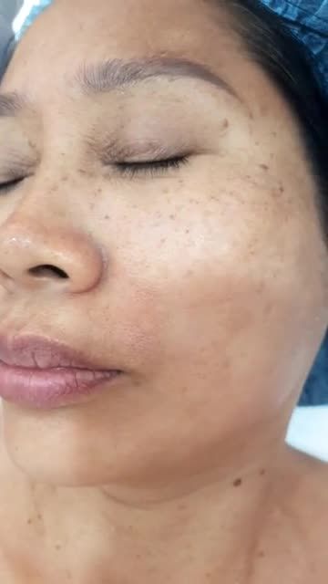 Điều trị mụn thịt lần đầu bằng Laser Factional Co2