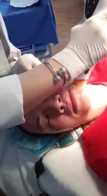 Thermage FLX Bí kíp trẻ hóa nhẹ nhàng Không phẫu thuật!