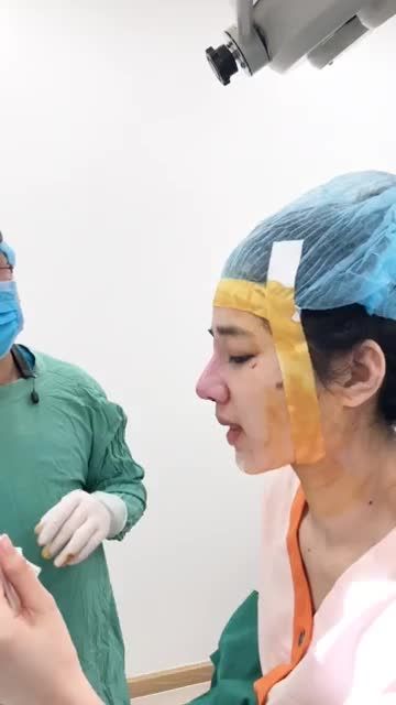 Ca nâng mũi cấu trúc cho khách hàng từng tiêm filler nâng mũi chỉ