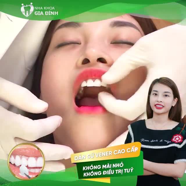 DÁN SỨ VENEER: THẨM MỸ RĂNG ĐỈNH CAO KHÔNG MÀI NHỎ