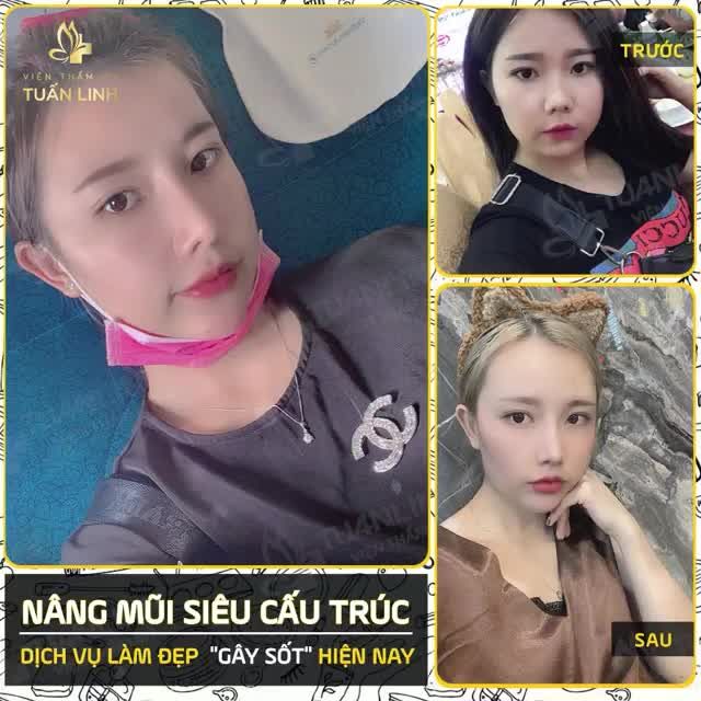 NÂNG MŨI SIÊU CẤU TRÚC  DỊCH VỤ " SIÊU HOT" ĐANG ĐƯỢC CHỊ EM " RẦN RẦN" ĐẶT LỊCH