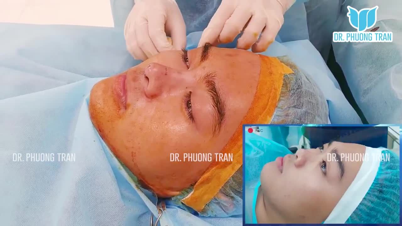 Nâng mũi xong bạn ấy nhìn gương và cười mãi thôi