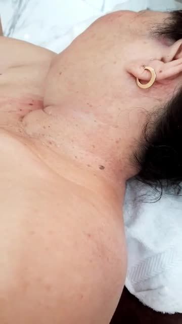 SẠCH MỤN THỊT DA sáng, KHÔNG tái phát