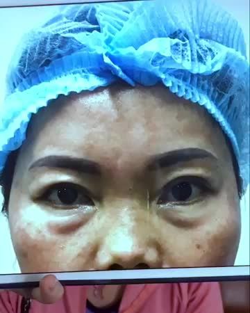 Sau khi sửa mí bao lâu có thể sinh hoạt bình thường? Mời quý khách hàng cùng theo dõi video sau đây!
