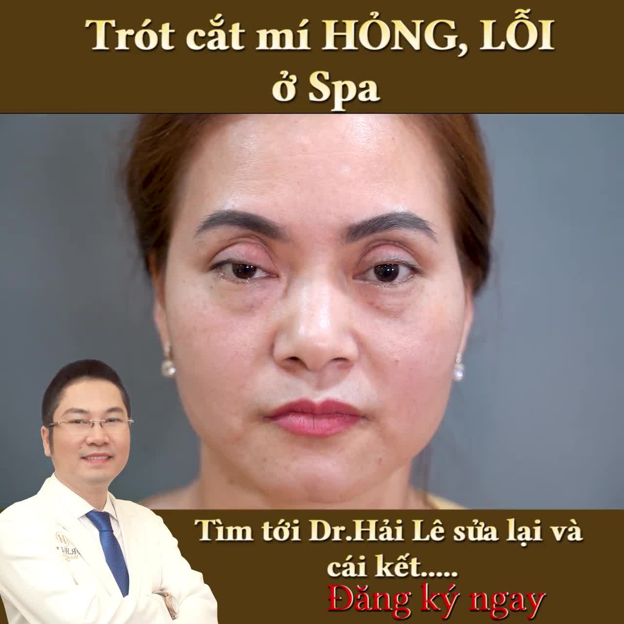 Chia sẻ chân thật của chị gái sau khi quyết định GIẢI CỨU MÍ LỖI HỎNG tại Dr.Hải Lê.