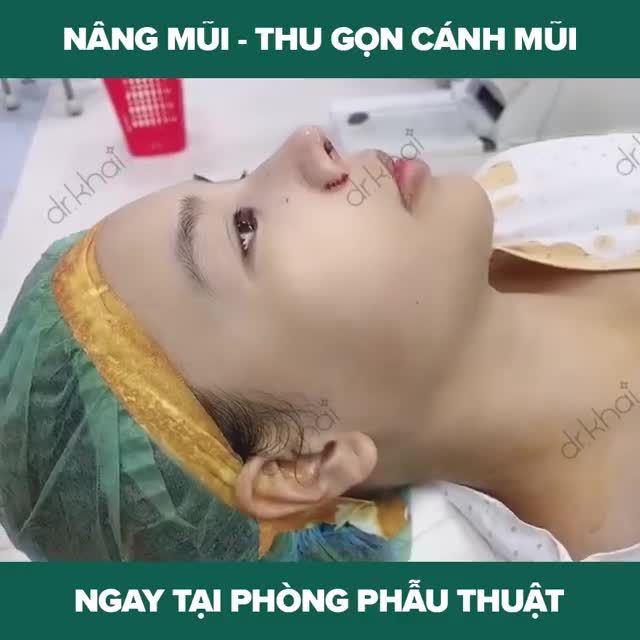 COMBO NÂNG MŨI CẤU TRÚC CAO TÂY KẾT HỢP THU GỌN CÁNH MŨI TẠI BS. ĐỖ QUANG KHẢI