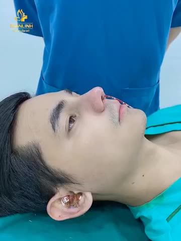 NÂNG MŨI CẤU TRÚC SURGIFORM CHO NAM