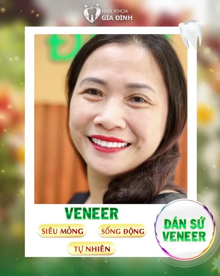 DÁN SỨ VENEER SIÊU MỎNG, KHÔNG MÀI NHỎ RĂNG, BẢO HÀNH UY TÍN TRỌN ĐỜI
