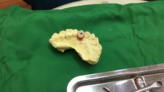 Lắp răng implant răng 14 cho chú Đức.