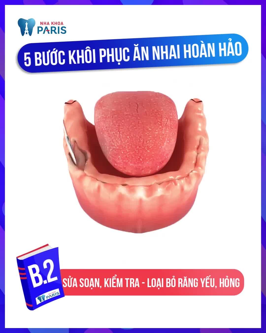 MẤT CẢ HÀM RĂNG ĐÃ KHÔNG CÒN LÀ NỖI LO
