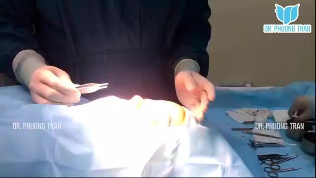 Toàn cảnh một ca mũi sụn sườn toàn phần tại bệnh viện