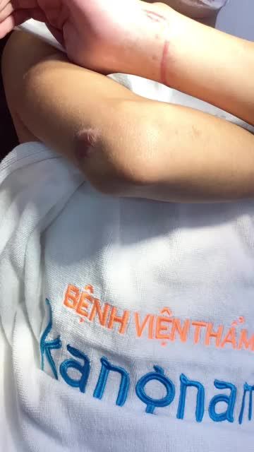XỬ LÝ SẸO LỒI sau tai nạn, có làm được không