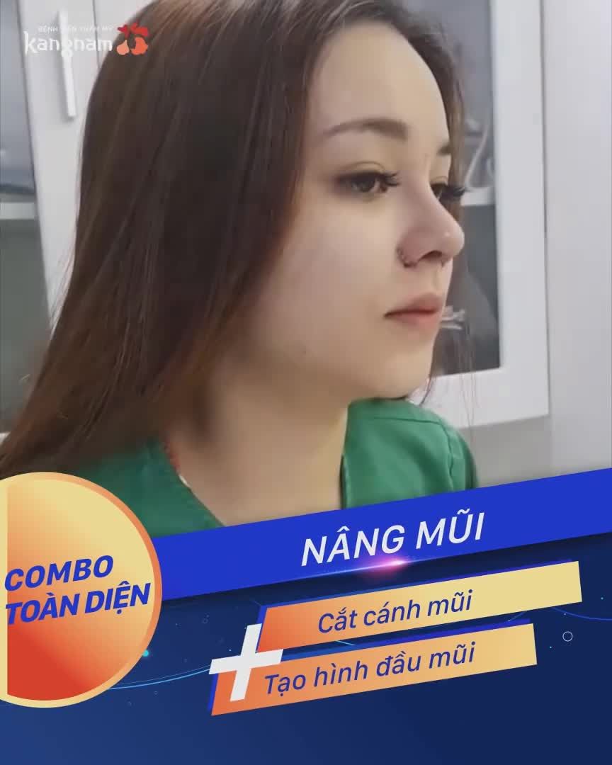 NÂNG MŨI KIỂU NÀO sẽ lên ngôi năm 2021