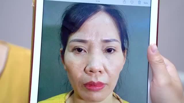 TRẺ RA 10 TUỔI SAU COMBO ĐỘN VÙNG TRÊN GÒ MÁ Cấy mỡ làm đầy má mời cả nhà cùng theo dõi sự thay đổi