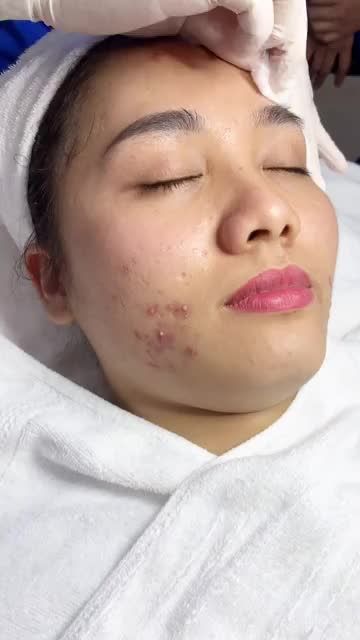 Đánh bật Mụn viêm với công nghệ TRỊ MỤN TẬN GỐC De-Acne
