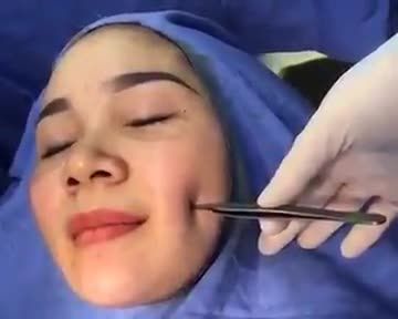 Tạo Má Lúm Cutie chỉ 4.5Tr Mừng khai trương