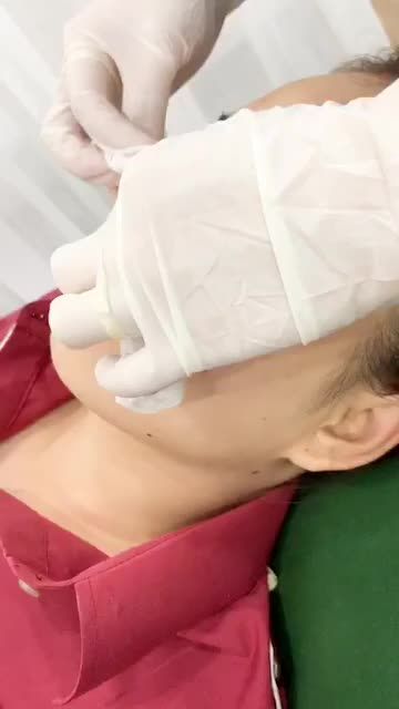 Ca nâng mũi cấu trúc sau 10 ngày tái khám