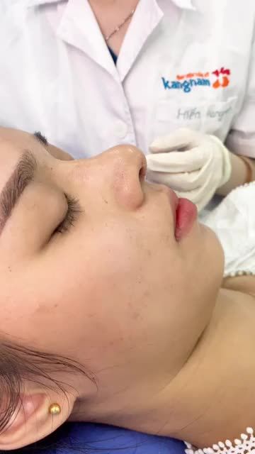 Cận cảnh cắt chỉ mũi sau 10 ngày nâng mũi cấu trúc 4D