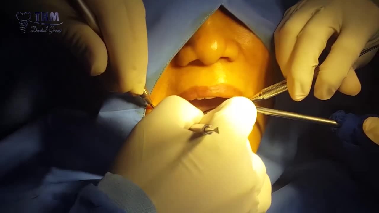 CẤY GHÉP IMPLANT VỮNG CHẮC KHÔNG MÀI RĂNG BÊN CẠNH