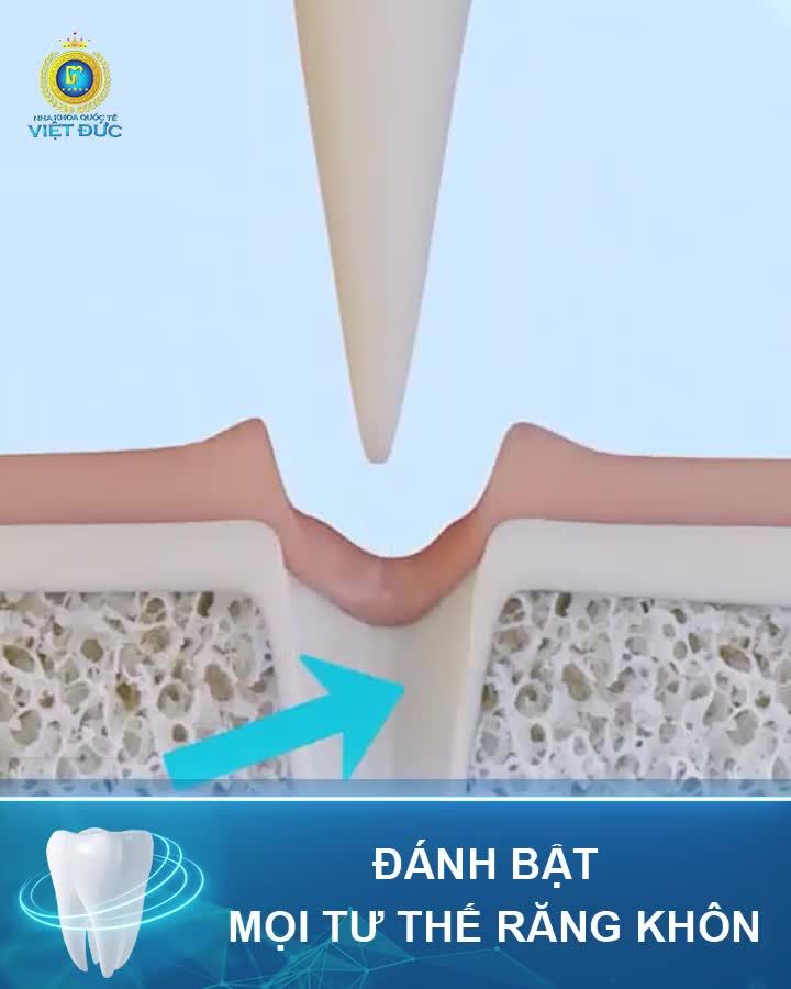 CÔNG NGHỆ NHỔ RĂNG SIÊU ÂM HIỆN ĐẠI SỐ 1 THẾ GIỚI 5 KHÔNG