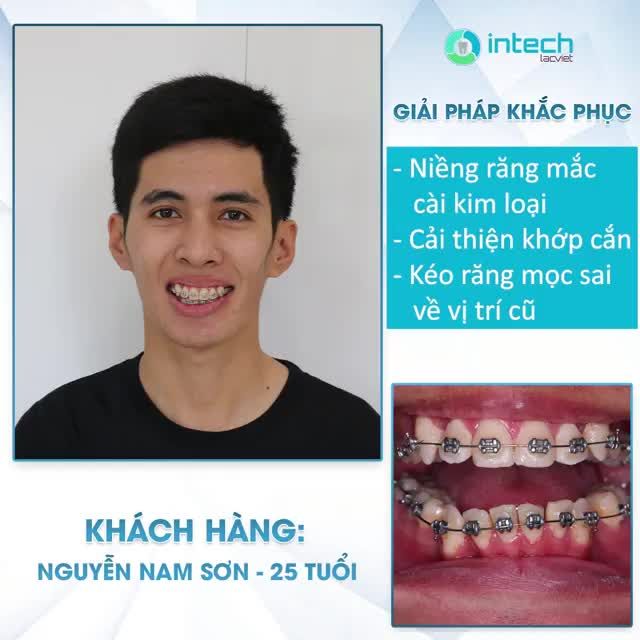 HÔ BIẾN HÀM RĂNG KHẤP KHỂNH NẶNG CHỈ SAU 4 THÁNG - Bạn có tin không??
