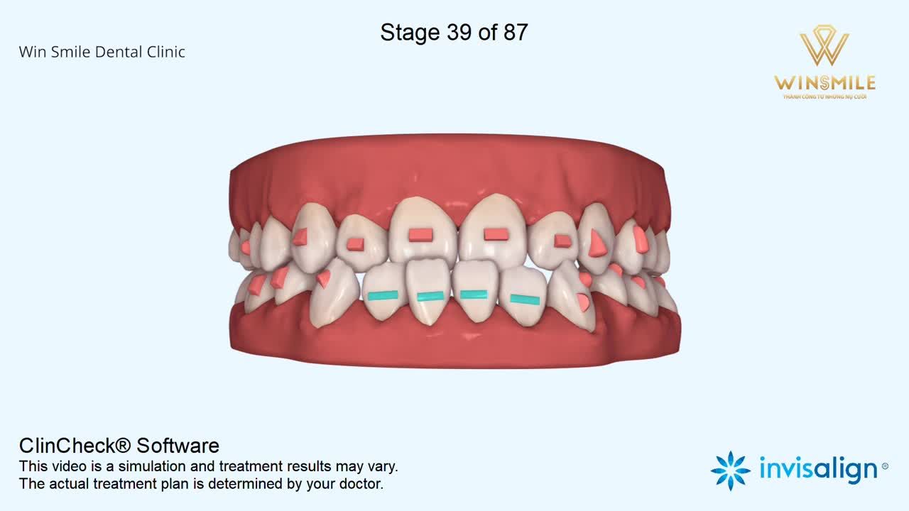 KHỚP CẮN HỞ CÓ LÀM KHÓ ĐƯỢC INVISALIGN