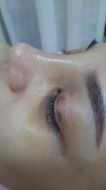 Live tream trực tiếp khách hàng Tái khám nâng mũi nhà Bs Kỳ