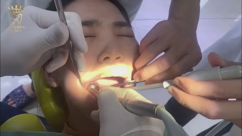 Nhổ răng khôn có đau không? Và đây là toàn bộ quá trình nhổ răng khôn mọc lệch tại Nha khoa XS DENTAL
