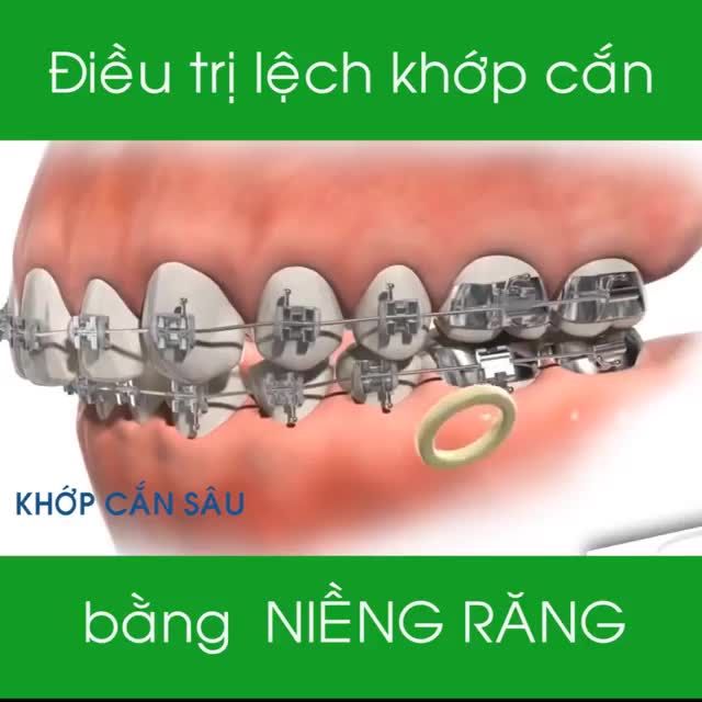SAI LỆCH KHỚP CẮN không chỉ gây ảnh hưởng đến thẩm mỹ của khuôn miệng và còn khiến cho việc ăn nhai trở nên khó khăn hơn.