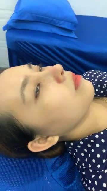TÁI KHÁM SAU 10 NÂNG MŨI SLINE SIÊU TỰ NHIÊN NHƯ MŨI THẬT