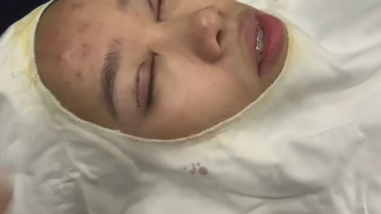 XỬ TRÍ LÕM HỐC MẮT TRONG với Dr Vương