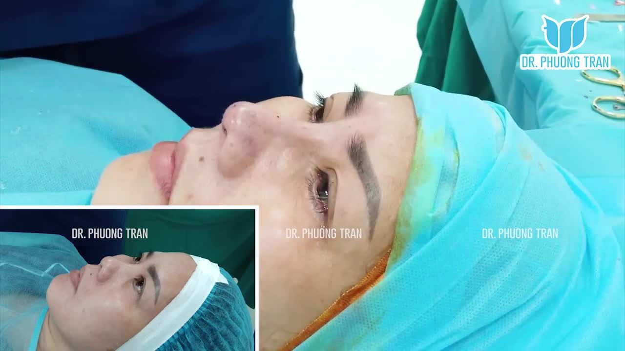Ca phẫu thuật diễn ra trong khoảng 60 phút với tất cả sự tâm huyết. Nền mũi thấp và ngắn đã được khắc phục hiệu quả.