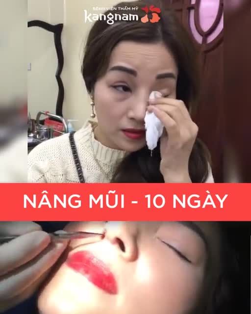 NÂNG MŨI KỊP TẾT Chia tay 2020 Chia tay Mũi thấp tẹt