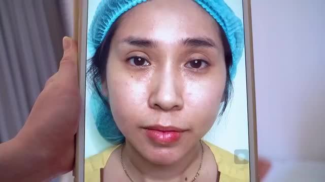 Giải cứu thành công ca mí lỗi hỏng do thực hiện tại Spa
