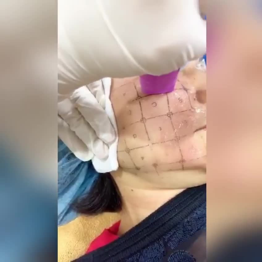 Công nghệ vượt bậc NÂNG CƠ XÓA NHĂN không xâm lấn