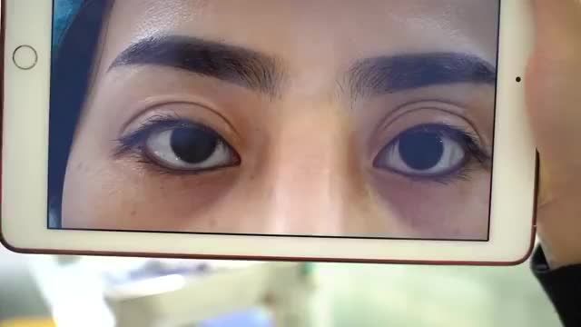 Bác sĩ làm việc xuyên trưa giải cứu thành công ca mí hỏng nặng sau khi thực hiện ở spa
