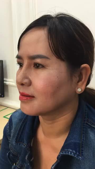 Khách hàng nâng mũi sline 4d 10 ngày sau phẫu thuật