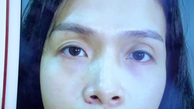 Sự thay đổi ngoạn mục xinh đẹp trẻ trung chỉ sau 60 phút thực hiện Cắt mí mk Nâng Cung mày