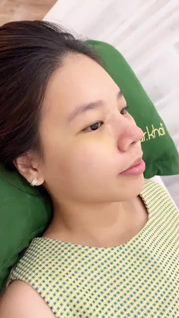 Mũi cấu trúc kết hợp cuộn cánh Chỉnh xương bè tái khám sau 10 ngày