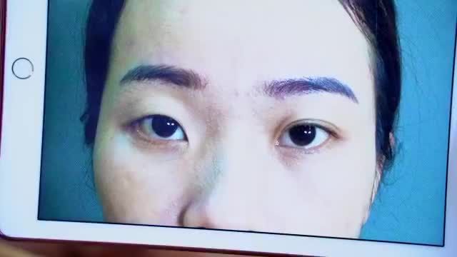 Nếu bạn sợ Cắt mí sưng/ đau/ bầm tím/ lâu bình phục thì không nên bỏ qua video cận cảnh quay khách hàng vừa thực hiện phẫu thuật xong để có câu trả lời