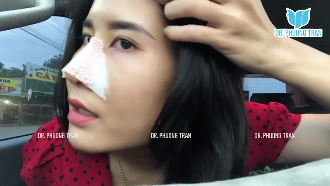 REVIEW THỰC TẾ CỦA KHÁCH HÀNG SAU 4 NGÀY NÂNG MŨI CẤU TRÚC