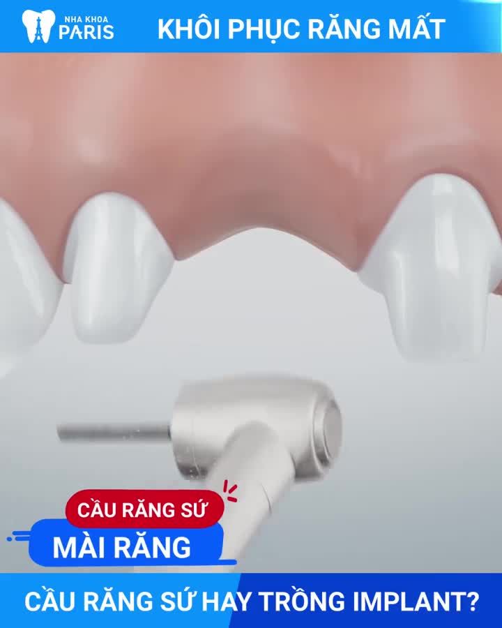 Trồng răng Implant Khôi phục răng mất do Tuổi Già Tai Nạn Sâu Vỡ